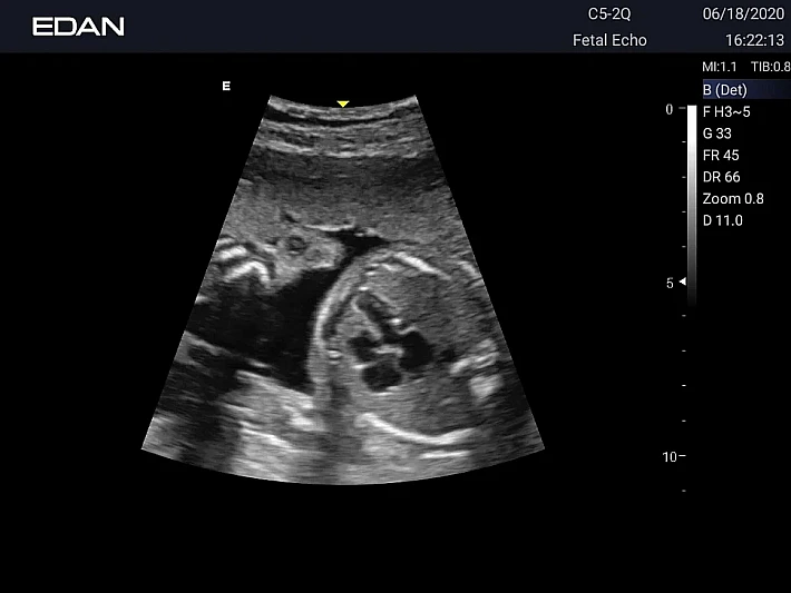 AX3 C5-2Q Fetus Heart (1)_result