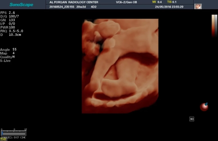 5. Ножка плода_result