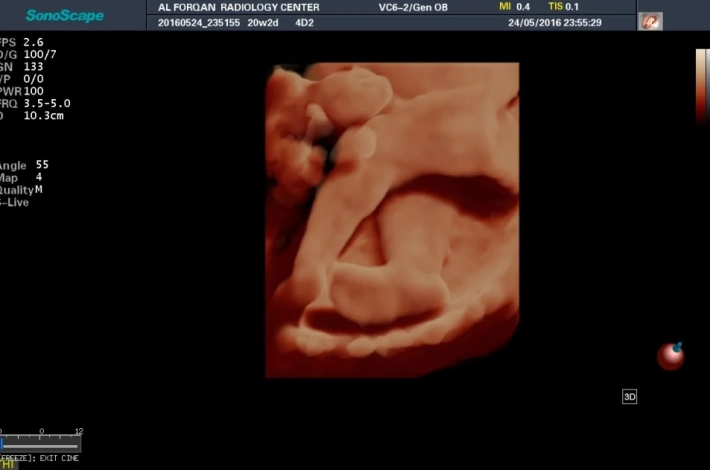 5. Ножка плода_result