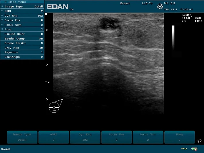 U50 PE  L15-7 Breast_result