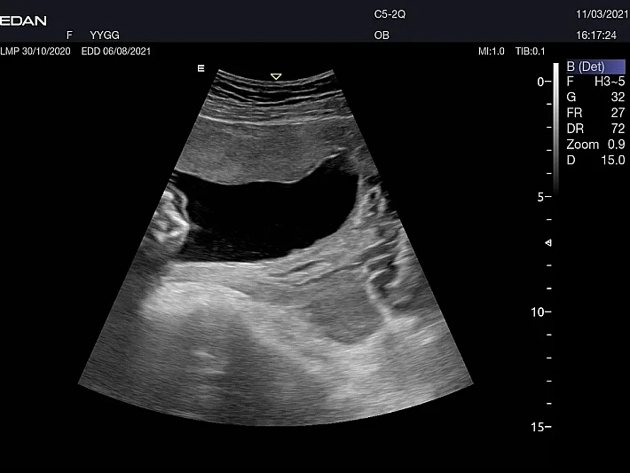 AX3 C5-2Q Fetus (9)_result