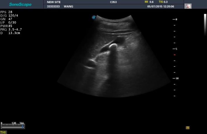 3. Желчнокаменная болезнь_result