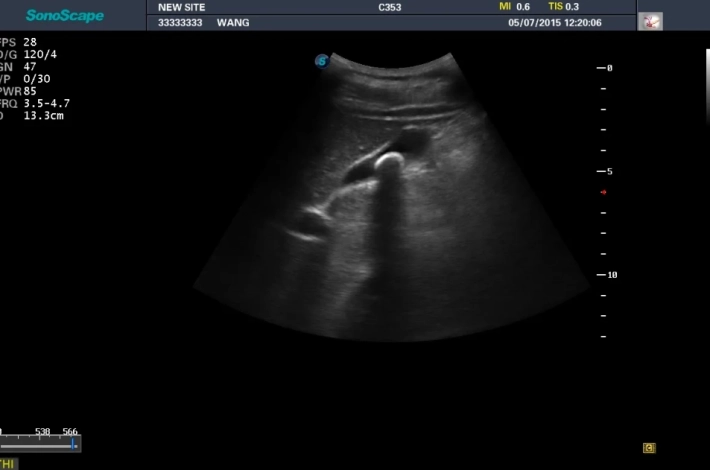 3. Желчнокаменная болезнь_result