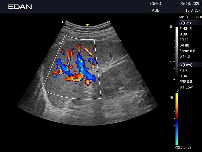 AX3 C5-2Q Liver (2)_result
