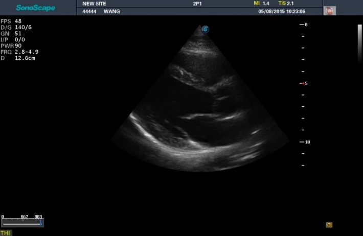 1. ЛЖ длинная ось_result