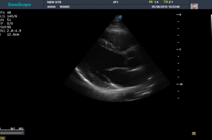 1. ЛЖ длинная ось_result