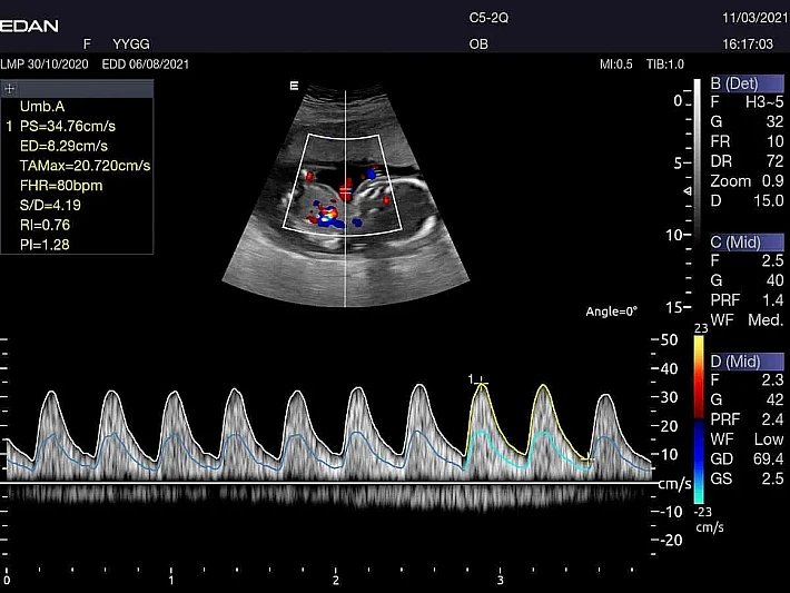 AX3 C5-2Q Umbilical cord blood flow (3)_result