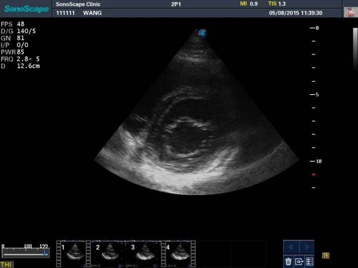 2. ЛЖ короткая ось_result