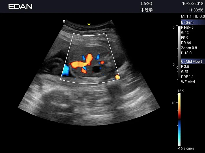 AX3 C5-2Q Umbilical cord blood flow (2)_result