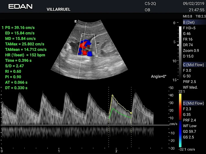 AX3 C5-2Q Umbilical cord blood flow (1)_result