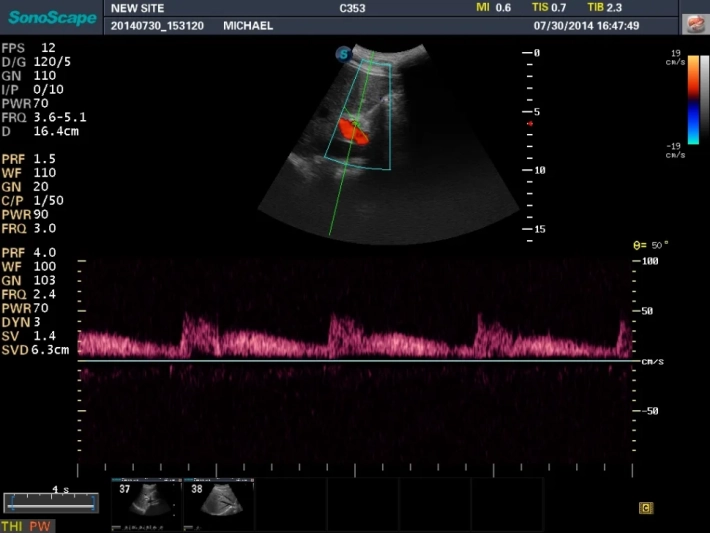 5. Печеночная артерия_режим импульсно-волнового допплера_result