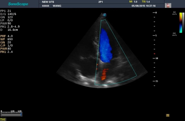3. Апикальная четырехкамерная позиция-ЦДК_result