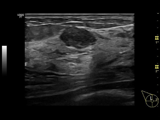 breast-lesion-l6-12.e11559ceafc2c1e437dabf0bb585bdb9519