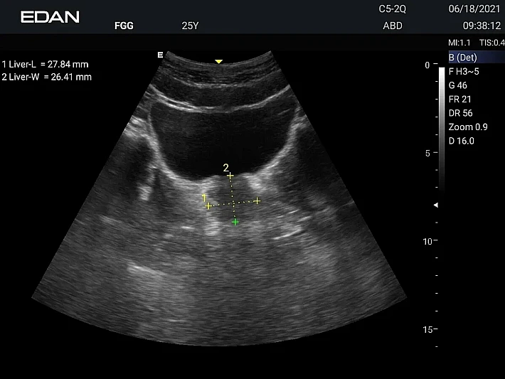 AX3 C5-2Q prostate_result