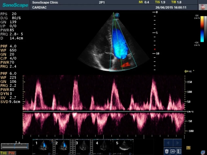 4. Митральный клапан_импульсно-волновой допплер_result