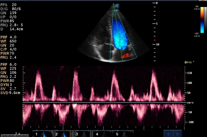 4. Митральный клапан_импульсно-волновой допплер_result