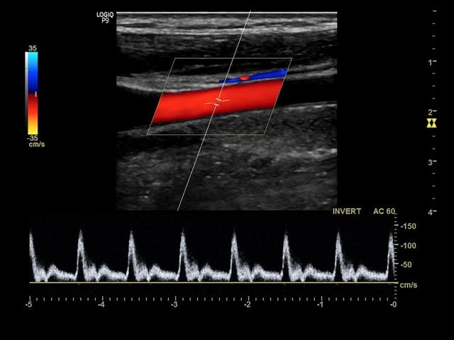 carotid-artery-9l.e11559ceafc2c1e437dabf0bb585bdb9519