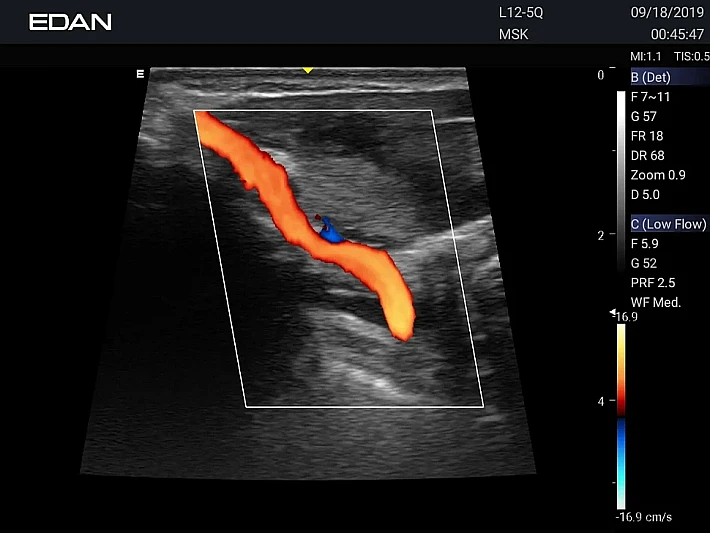AX3 L12-5Q Upper limb blood vessel (1)_result