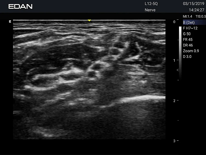 AX3 L12-5Q Nerve_result