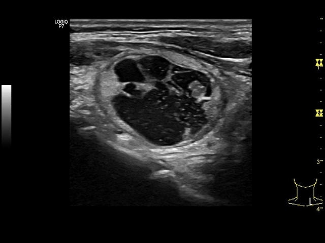 thyroid-l6-12.e11559ceafc2c1e437dabf0bb585bdb9519