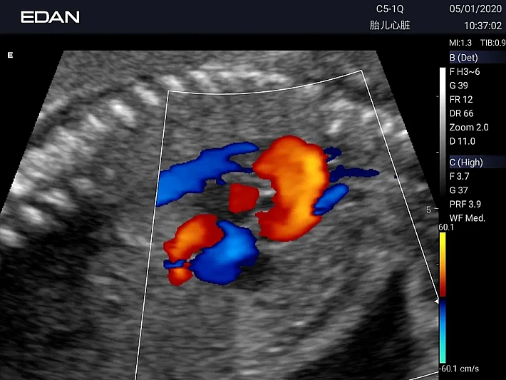 Fetal Heart3_result
