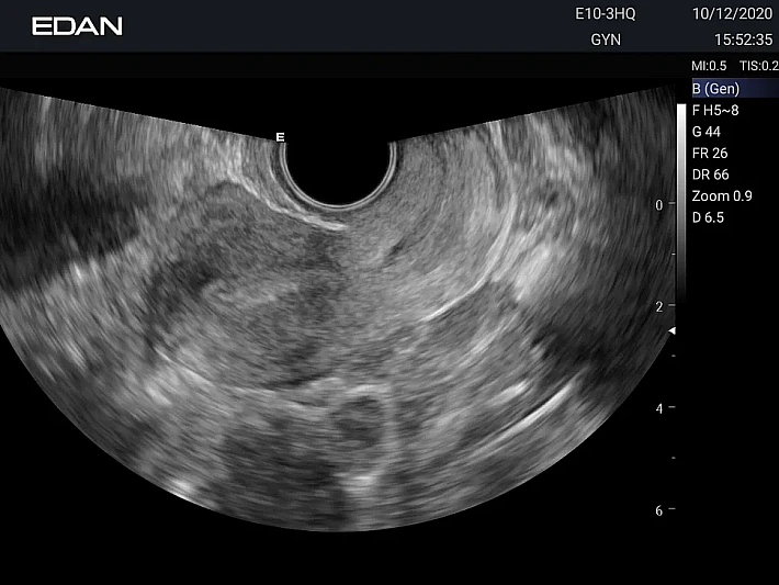 E10-3HQ Uterus_result
