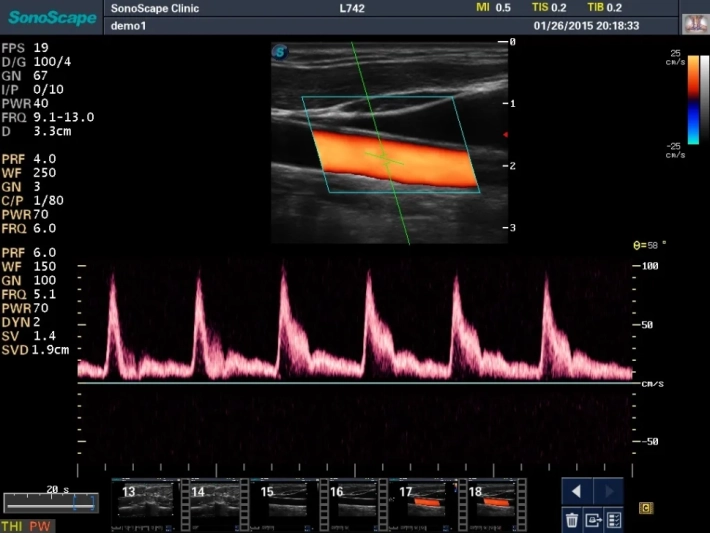 14. Общая сонная артерия_режим импульсно-волнового допплера_result