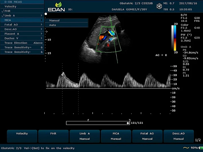 U50PE C352UB Fetus Umbilical cord blood flow(9)_result