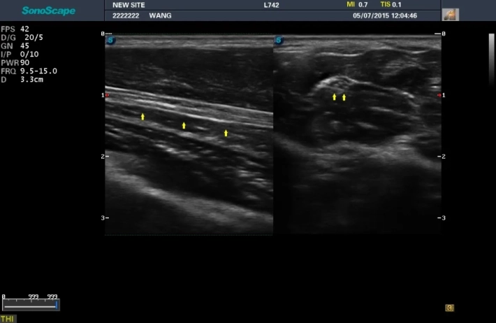 8. Срединный нерв_result