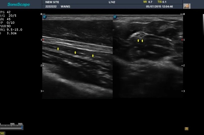 8. Срединный нерв_result