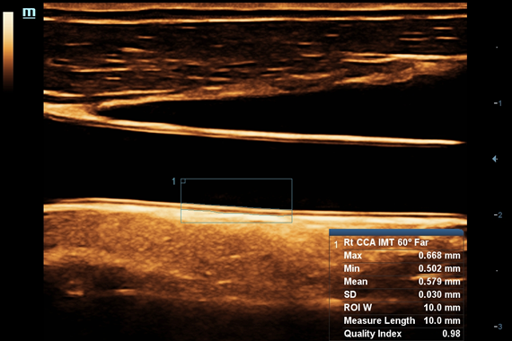 mindraysss3_2022-11-24-135718_cyhx