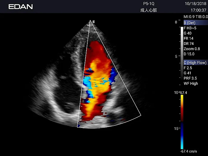 AX3 P5-1Q Cardiac(5)_result