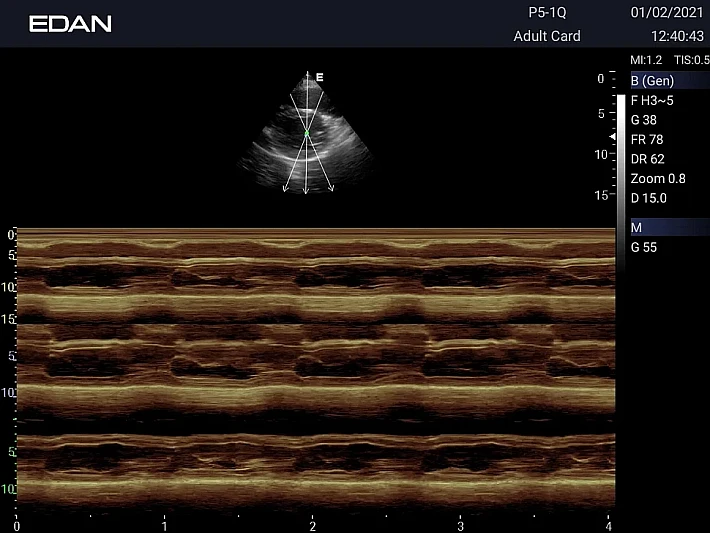 AX3 P5-1Q Cardiac(3)_result