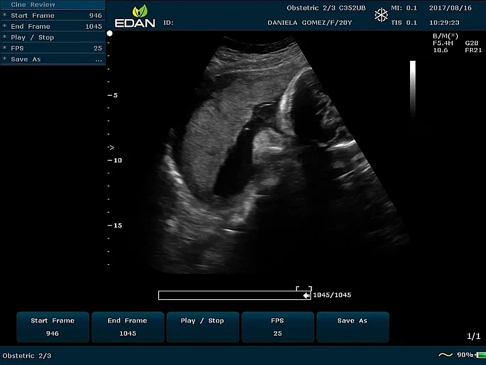 U50PE C352UB Fetus (1)_result