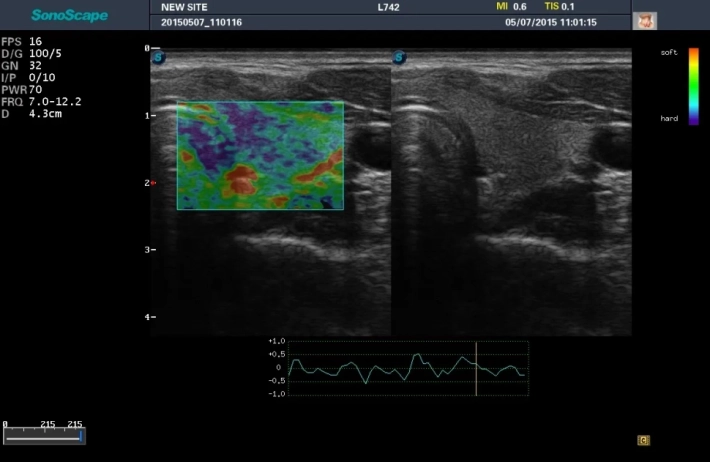 12. Эластография_result