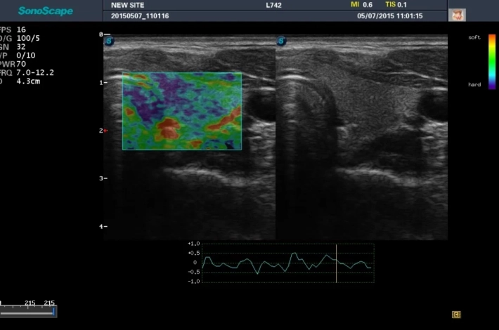 12. Эластография_result