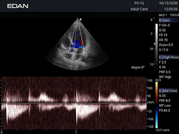 AX3 P5-1Q Cardiac(2)_result