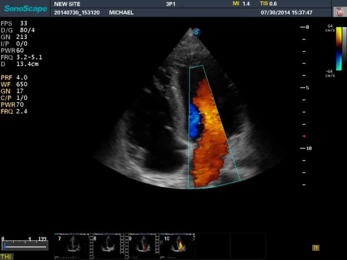 7. Апикальная четырехкамерная позиция-ЦДК_result