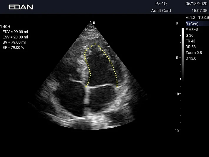 AX3 P5-1Q Cardiac(1)_result