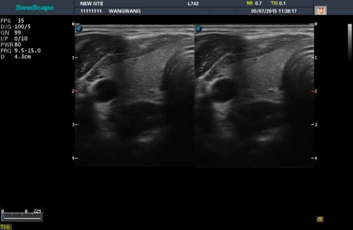 6. Щитовидная железа_режим 2B_result