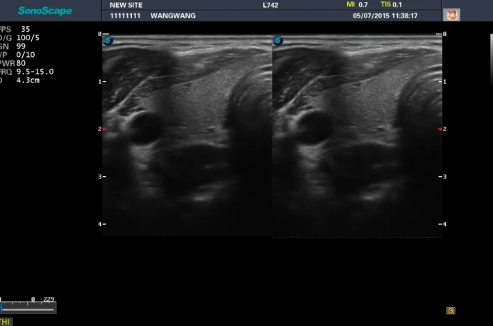 6. Щитовидная железа_режим 2B_result