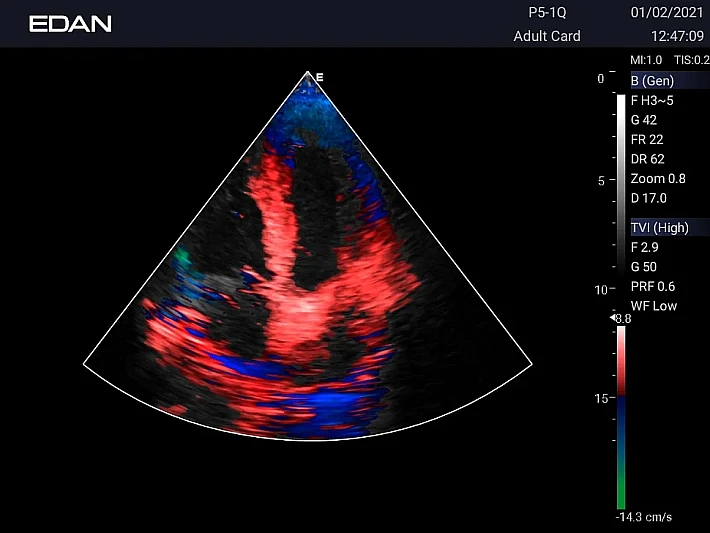 AX3 P5-1Q Cardiac TDI  (5)_result