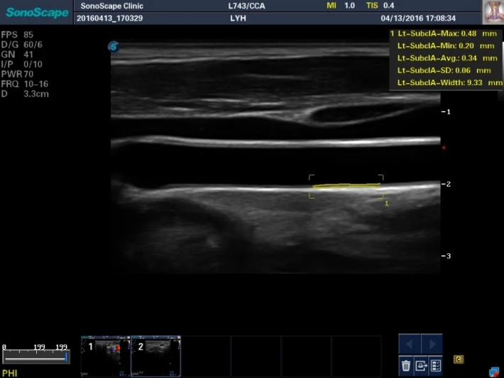 10. Общая сонная артерия_интима-медиа_result