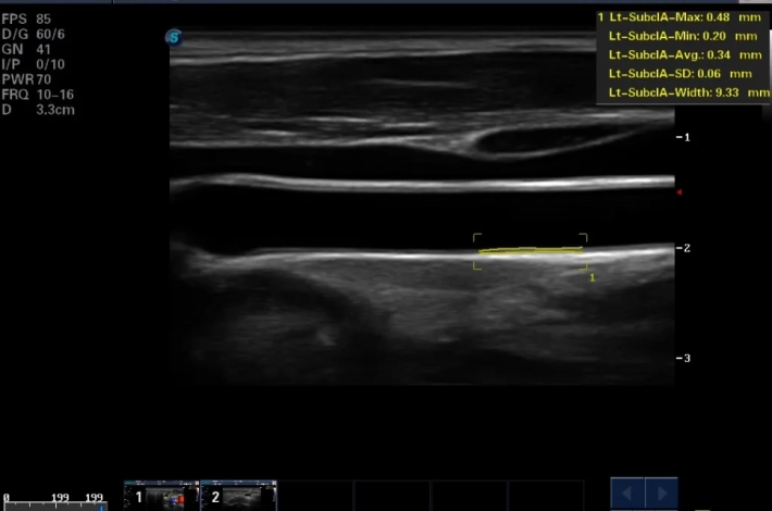10. Общая сонная артерия_интима-медиа_result
