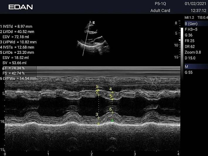 AX3 P5-1Q Cardiac M mode (3)_result