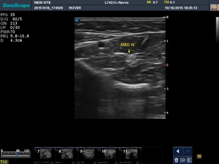 9. 5. Срединный нерв_result