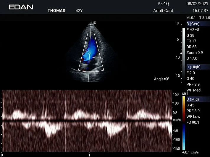 AX3 P5-1Q Cardiac (3)_result