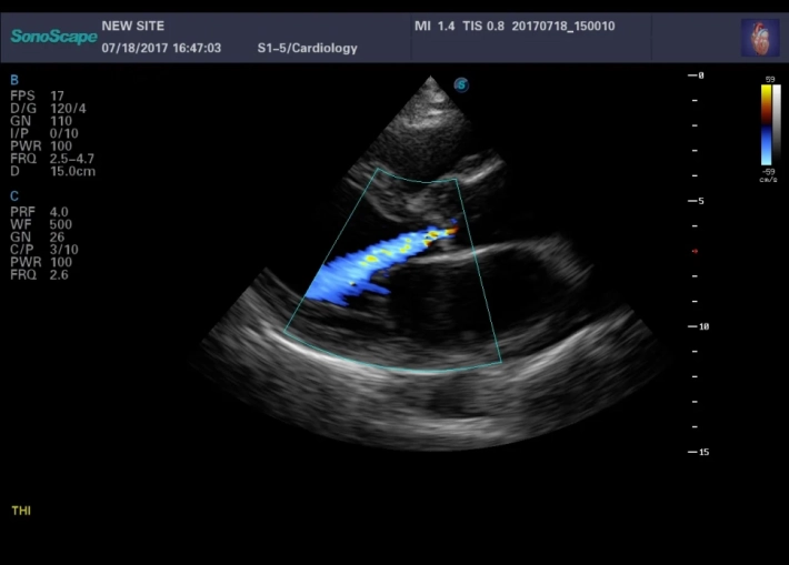 3. Аортальная регургитация_result