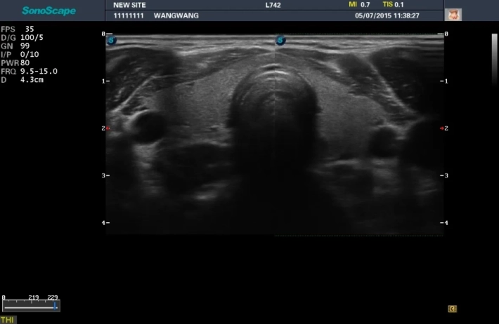 7. Щитовидная железа_result