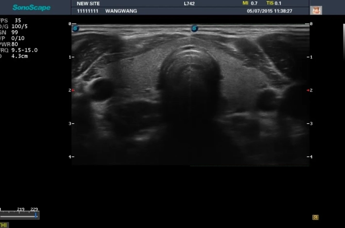 7. Щитовидная железа_result